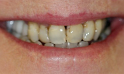 Extremely decayed and damaged teeth