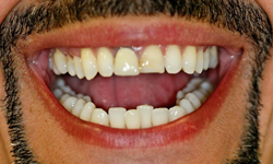 Darkly stained and damaged teeth