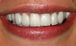 Teeth repaired and gap closed between front teeth