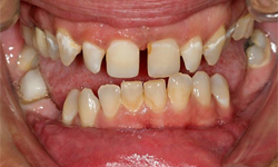 Damaged teeth and gap between front teeth