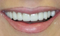 Flawless smile after veneer and crown makeover