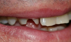 Cracked and damaged tooth