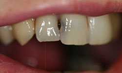 Decayed teeth with dark stains