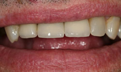 Front tooth after whitening