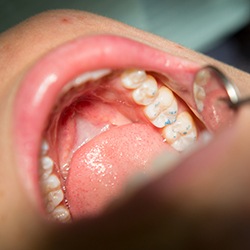 Closeup of teeth during dental restoration