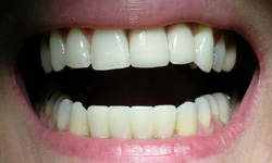 Flawless implant supported repalcement teeth