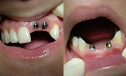 Implants in place to support a replacement tooth