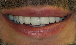 Healthy straight flawless teeth