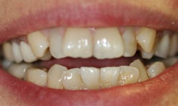 Croded and overlapping teeth