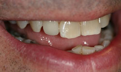 Flawlessly repaired tooth