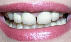 Large gap between front teeth