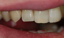 Healthy repaired teeth