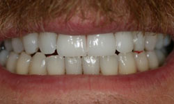 Repaired front tooth