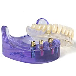 Model of All-on-4 denture