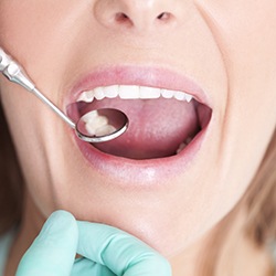 Closeup of patient during dental exam