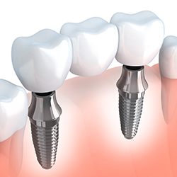 Animation of implant supported bridge