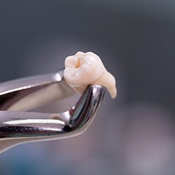 a pair of dental forceps holding a molar
