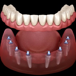 implant-retained denture