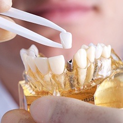 Model of implant supported dental crown