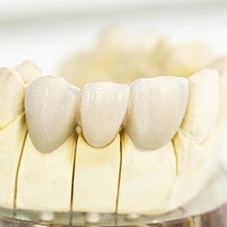 Model of dental implant with crown