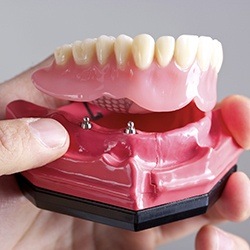 Model of implant supported denture