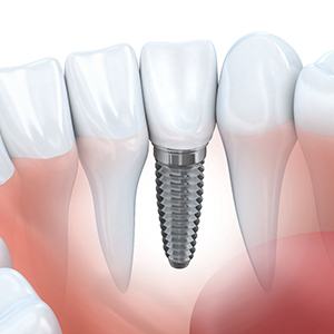 A diagram of a dental implant