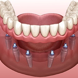 A diagram of an implant denture