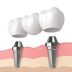 Dental implant bridge