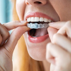 Woman inserting Invisalign in Homer Glen