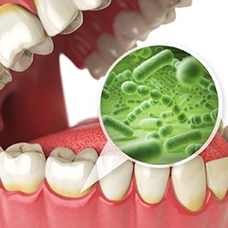 diagram of bacteria in gum disease