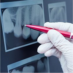 Root canal x-ray