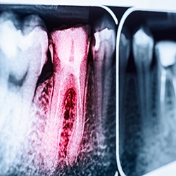 X-ray of root canal treated tooth