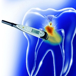 Diagnodent cavity detection