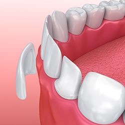 Animation of porcelain veneer