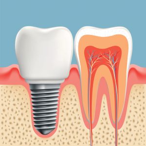 Restore your smile with dental implants in Homer Glen.