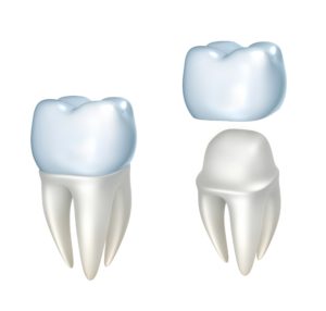 digital model of dental crown