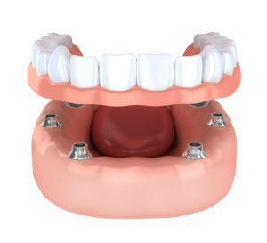 implant-supported denture