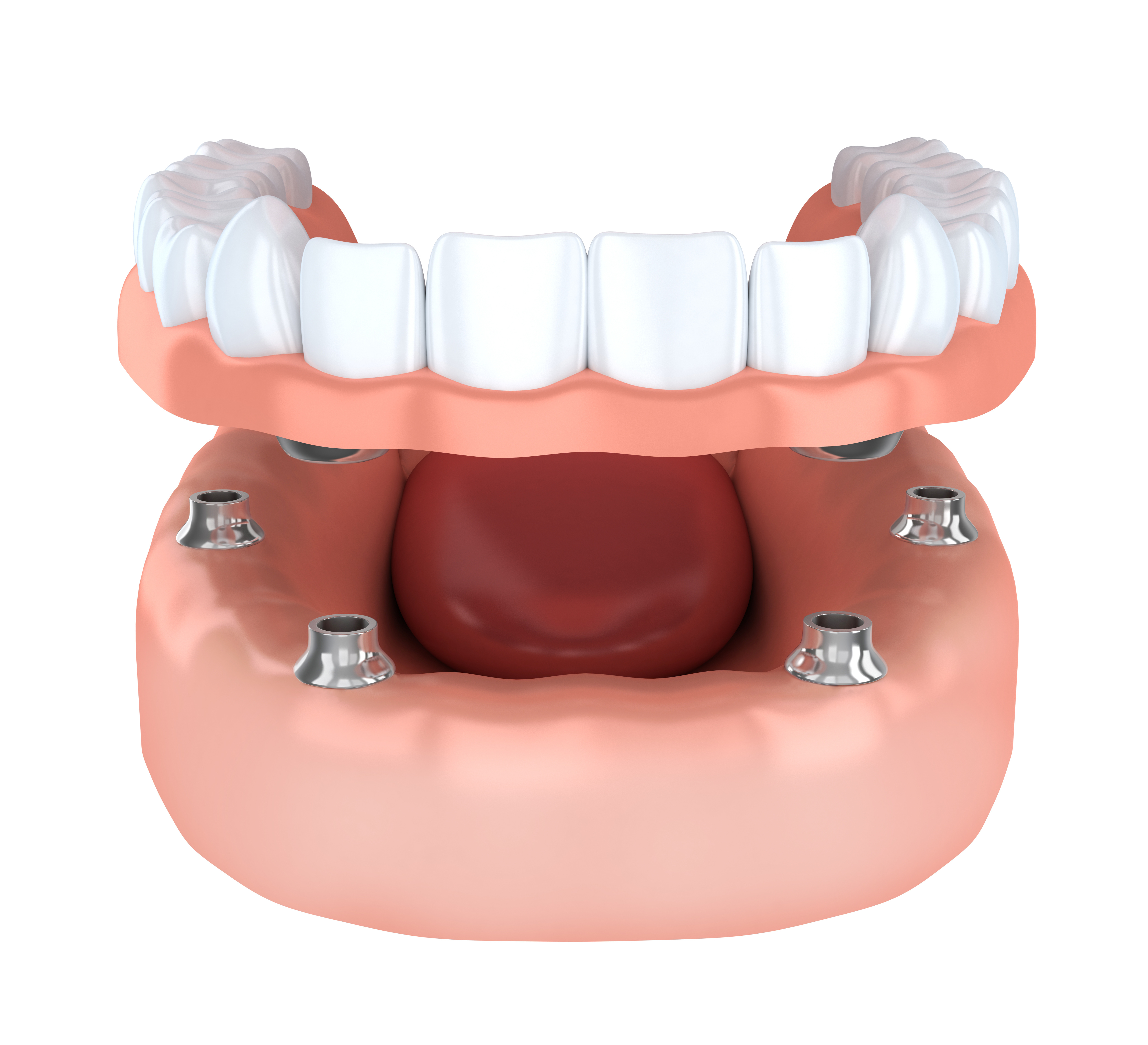 Dental Implants in Murrieta, CA