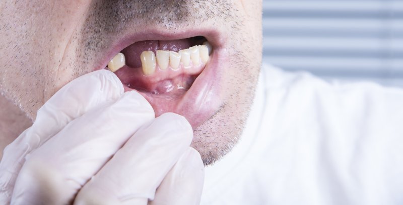 a man wearing a glove and pulling his lower lip down to expose his missing tooth