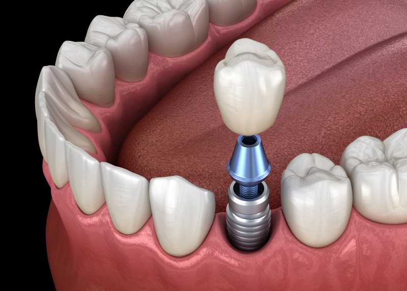 3D render of implant and crown for lower front tooth