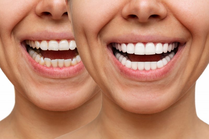 side by side of a set of teeth before and after cosmetic dentistry