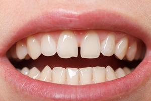 picture of someone with gapped teeth