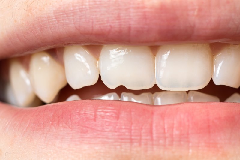 A closeup of a person’s chipped tooth