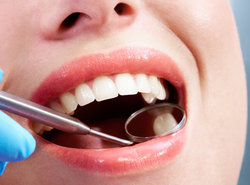 Close up of patient's mouth with filling illuminated by dental mirror